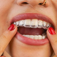 Woman inserting a clear aligner