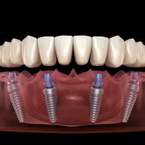 All-on-4 dental implants