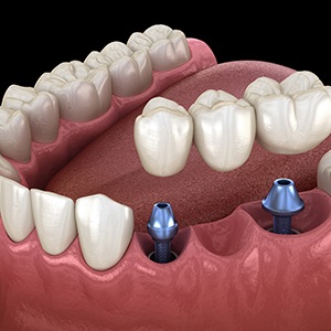 Dental implant bridge in Naperville