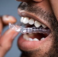 Man inserting aligners to fit snugly against a set of teeth