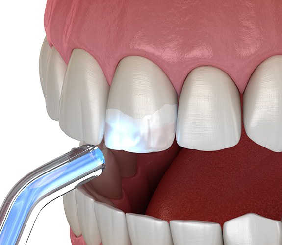 Digital image of dental bonding