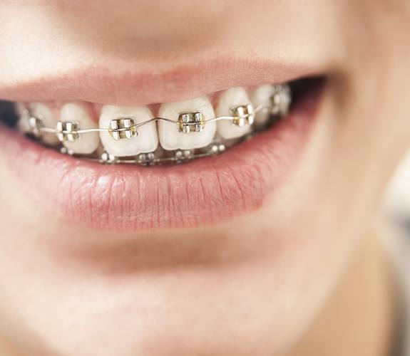 Close-up of smiling person with braces in Naperville, IL