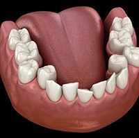 Digital image of crowded teeth