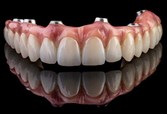 Implant dentures in Naperville 