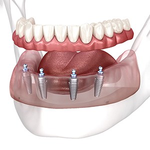 Implant dentures in Naperville