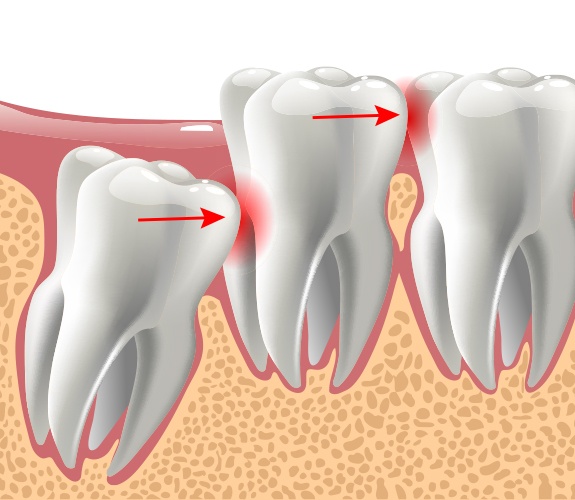 Animated smile with impacted tooth before tooth extraction