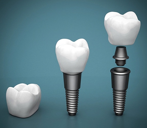 Understanding cost of dental implants in Naperville
