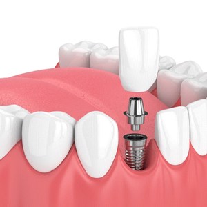 Dental implant in Naperville