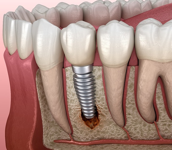 Woman after failed dental implant in Naperville