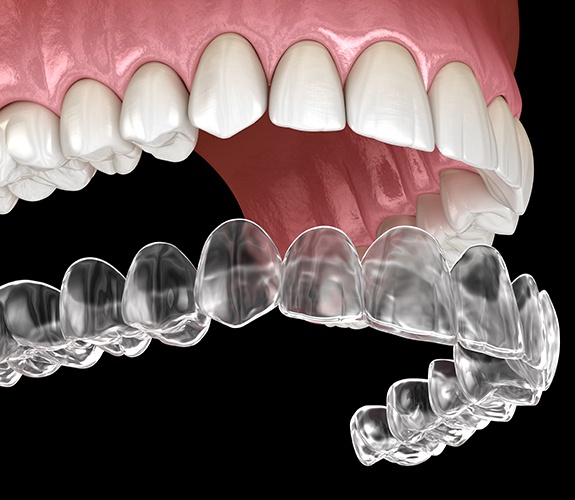 Animated smile with Invisalign tray