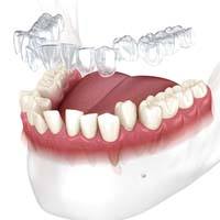 Invisalign aligner in Naperville