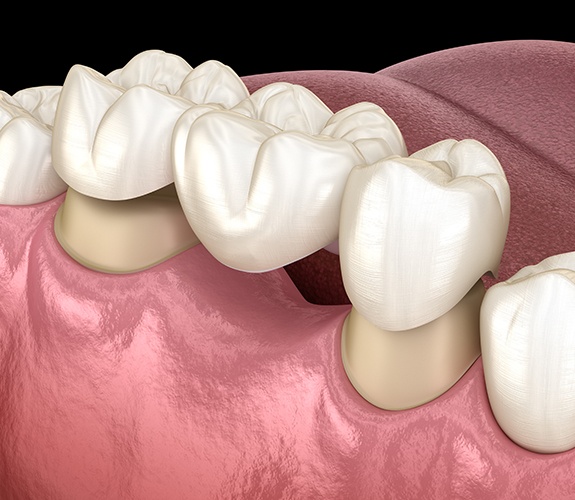 Animated smile during dental bridge placement