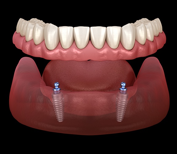 Animated smile during dental implant supported denture placement