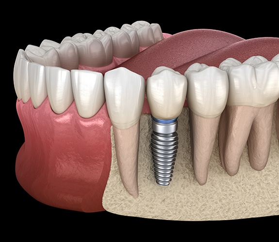 Animated dental implant supported dental crown placement