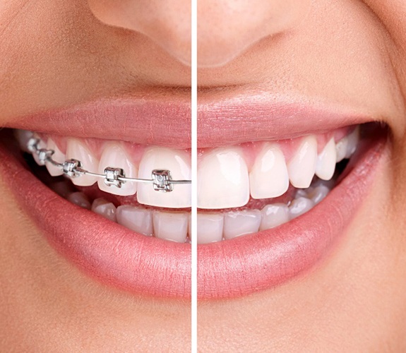 Close-up of smile during and after orthodontics in Naperville, IL