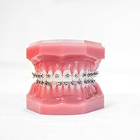 Model of braces for orthodontics in Naperville, IL