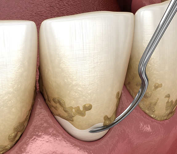 Animated smile during scaling and root planing gum disease treatment