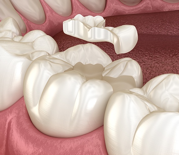 Animated smiling during tooth colored filling placement