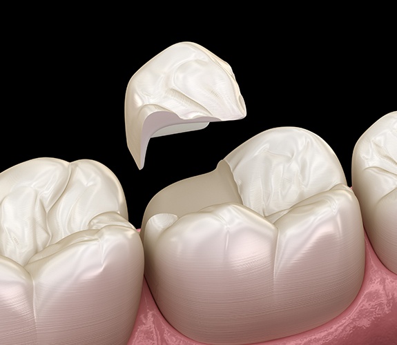 Animated smile during porcelain onlay placement