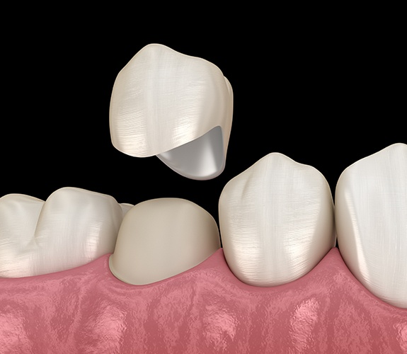 Animated smile during dental crown placement