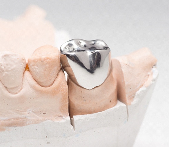 Stainless steel dental crown on model of arch of teeth