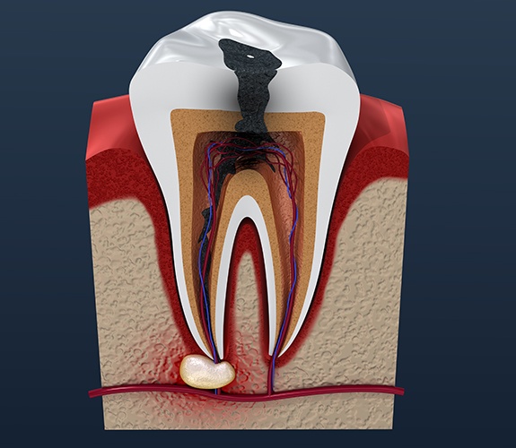 Animated tooth with infection before root canal therapy