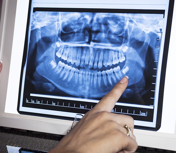 Digital dental x-rays