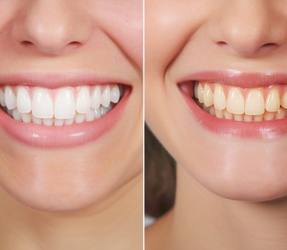 Before and after image of teeth whitening