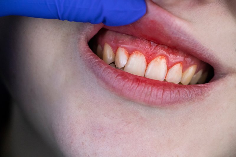 patient with gum disease in Naperville 