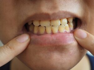 person with yellow teeth