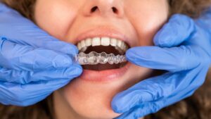 a dentist inserting a clear aligner onto a top row of teeth